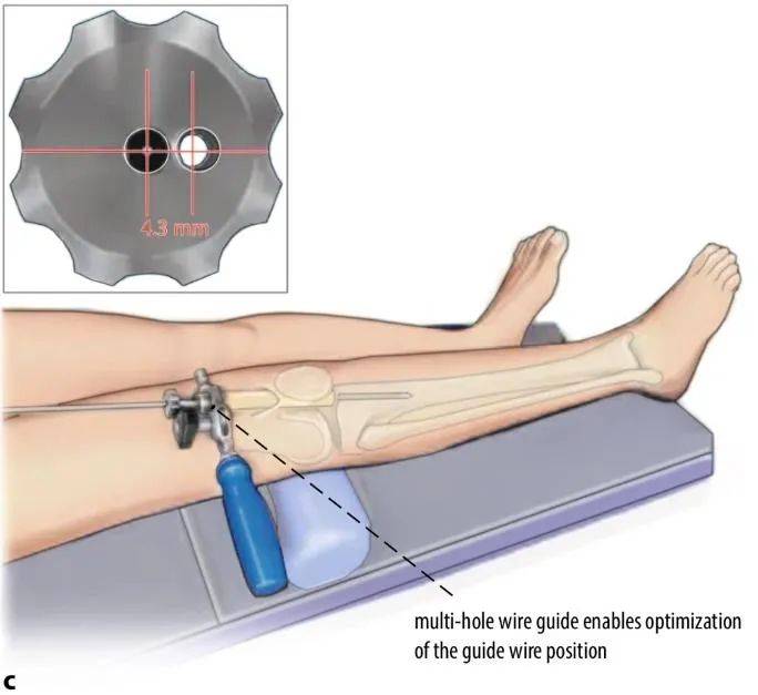 Fracturas de tibia, t&eacute;cnica de clavo intramedular suprapatelar-9
