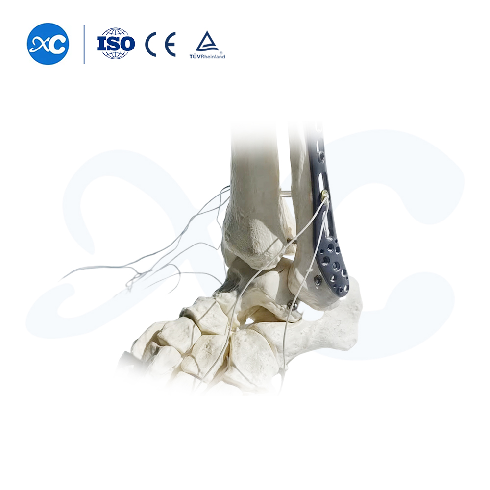 Placa de bloqueo tibioperoneo distal-III