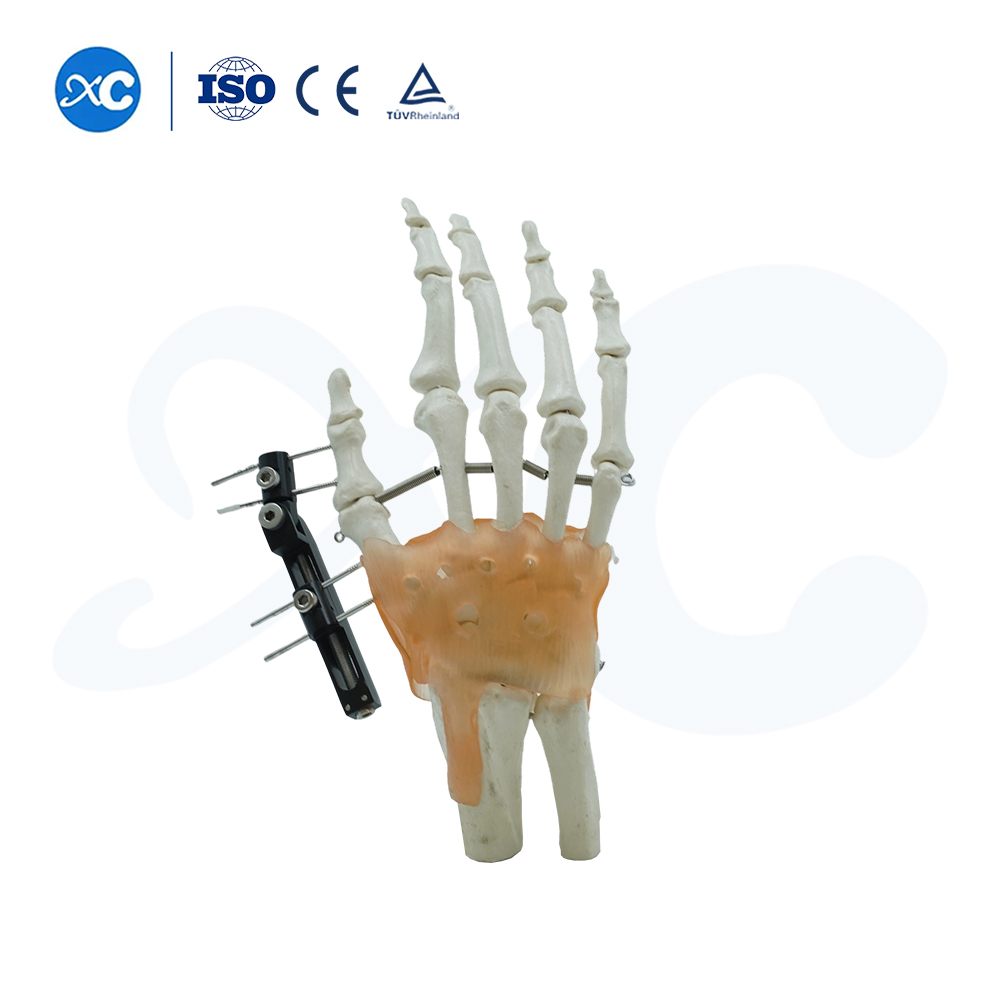 Fijación Externa Para Metacarpianos Y Falanges