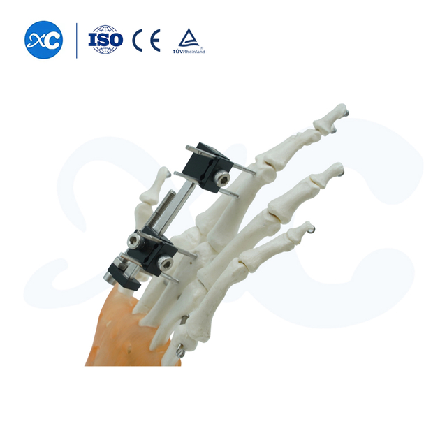Fijación Externa Para Metacarpianos Y Falanges