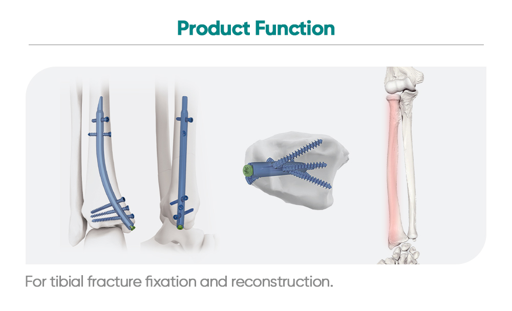 Clavo tibial distal Sistema de fijaci&oacute;n intramedular retr&oacute;grada | Ortopedia XC Medico