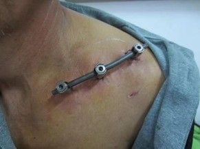 M&eacute;todo alternativo de fijaci&oacute;n de fracturas de clav&iacute;cula.