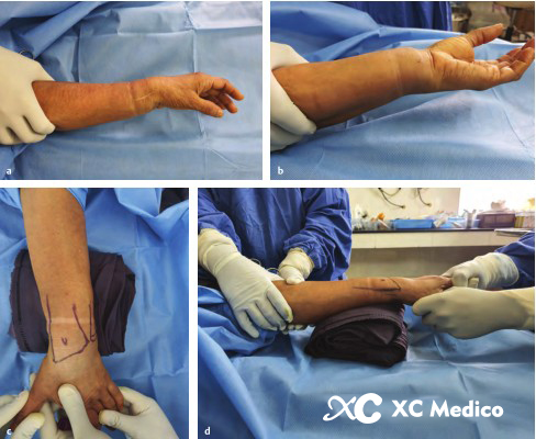 con aguja de Kirschner dorsal y espec&iacute;fica del fragmento de fractura de radio distal 