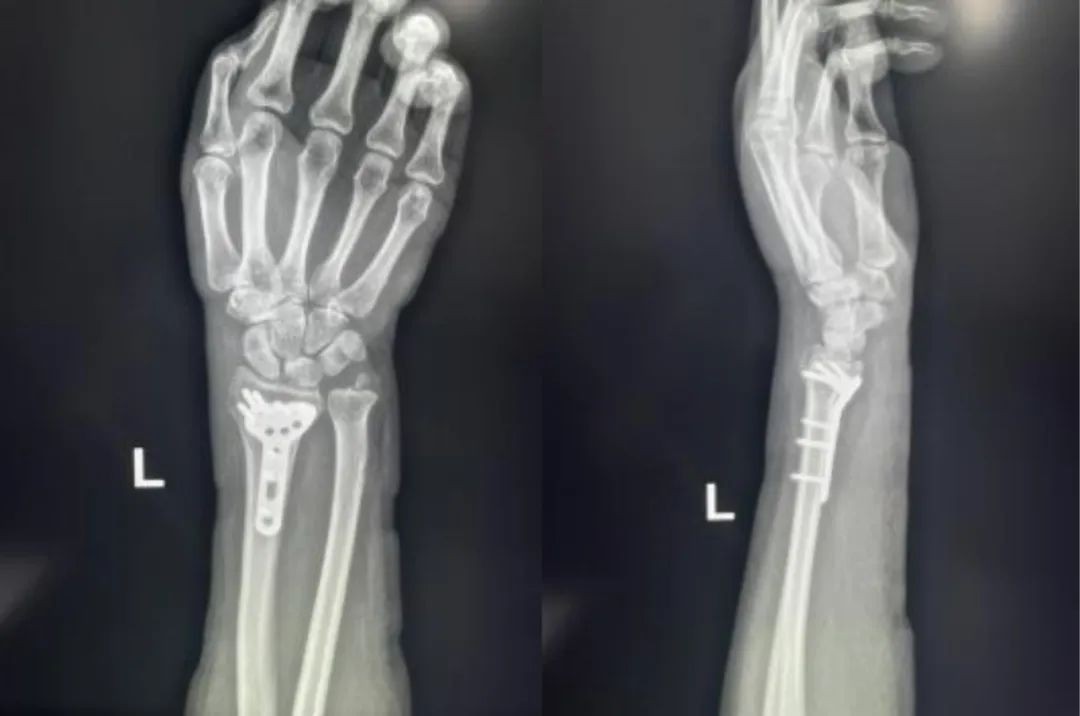 Fractura compleja de radio distal antes de la fijaci&oacute;n de placa volar 