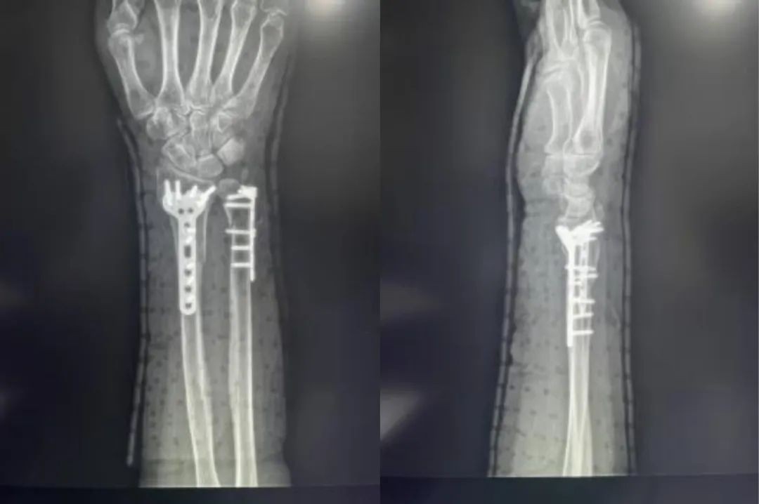 Radiograf&iacute;a PA posoperatoria de fijaci&oacute;n de placa de radio distal volar 