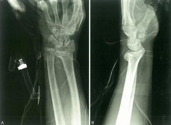 Sistema de fijaci&oacute;n espec&iacute;fico de fragmentos para fracturas de radio distal 