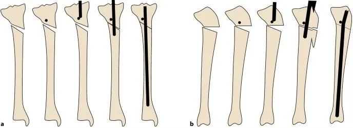 Fracturas de tibia, t&eacute;cnica de clavo intramedular suprapatelar-20