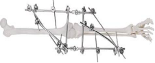 Fijador combinado para articulaci&oacute;n de rodilla