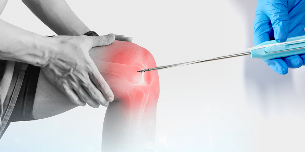 Se muestra un instrumento de colocaci&oacute;n de anclaje de sutura de titanio para un procedimiento de ligamento de rodilla seleccionado