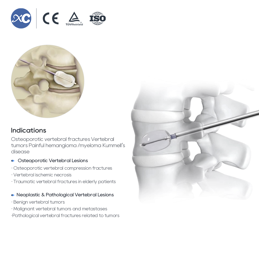 Sistema de cifoplastia (PKP/PVP): kit de cemento y globo para el cuerpo vertebral
