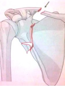 Lesiones asociadas consideradas en el tratamiento de la fractura de clav&iacute;cula