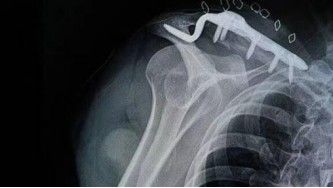 Conjunto de fijaci&oacute;n de fractura de clav&iacute;cula distal