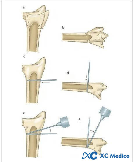 Principio de fijaci&oacute;n intrafocal de Kapandji para una fractura de radio distal 