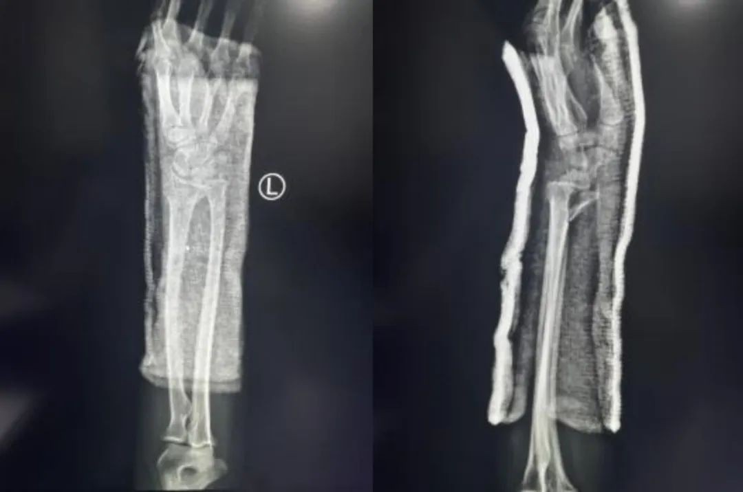 Radiograf&iacute;a lateral posoperatoria de fijaci&oacute;n de placa de radio distal volar 