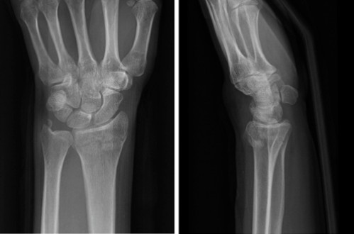 Anatom&iacute;a del abordaje dorsal para la fijaci&oacute;n con placa del radio distal 