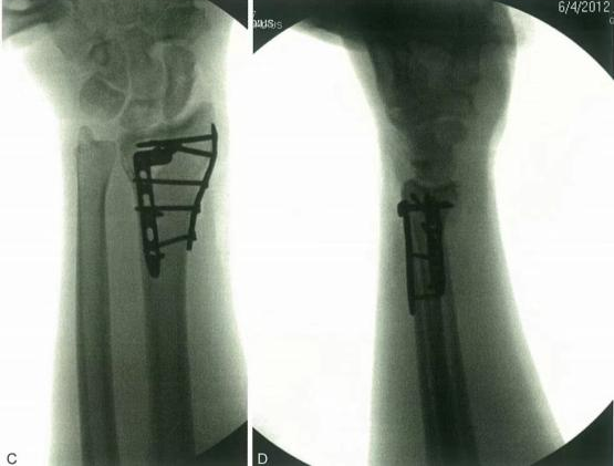 Radiograf&iacute;a de fijaci&oacute;n de fracturas de radio distal espec&iacute;fica de fragmentos