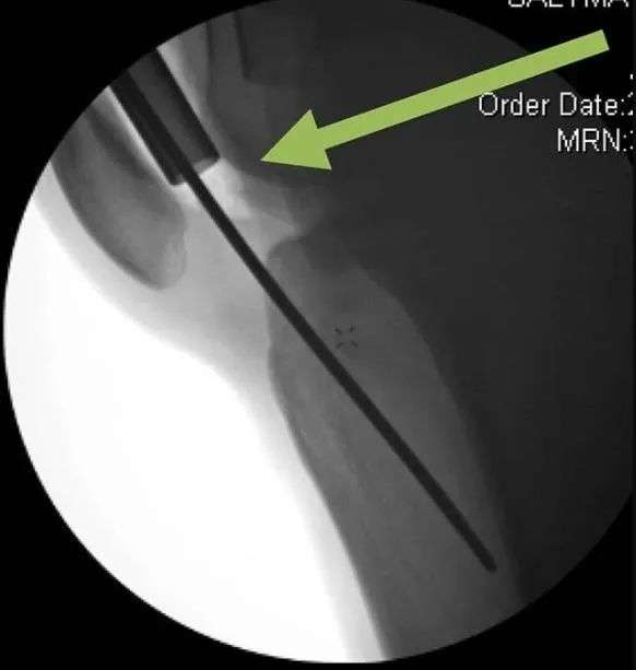 Fracturas de tibia, t&eacute;cnica de clavo intramedular suprapatelar-22