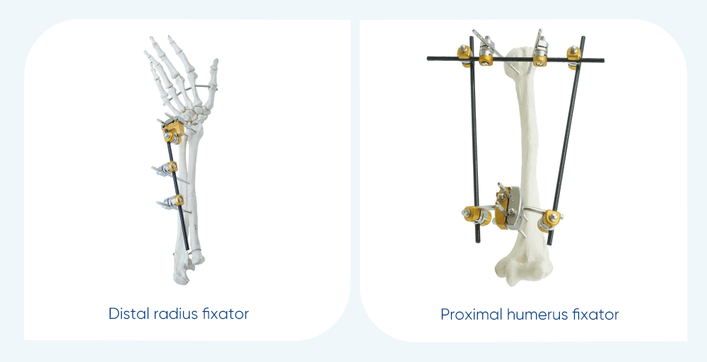 Configuraci&oacute;n del fijador externo de antebrazo
