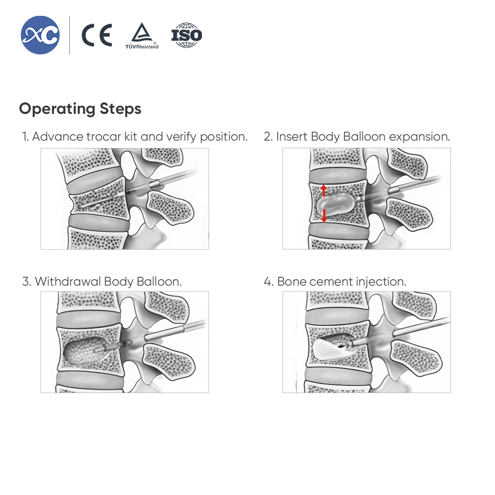 Sistema de cifoplastia (PKP/PVP): kit de cemento y globo para el cuerpo vertebral