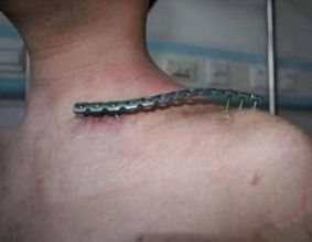 M&eacute;todo de fijaci&oacute;n para una fractura compleja de clav&iacute;cula.