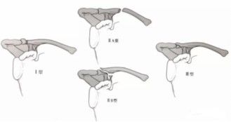 Clasificaci&oacute;n de Neer de las fracturas de clav&iacute;cula distal