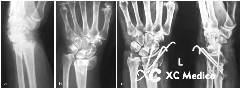 Evaluaci&oacute;n fluorosc&oacute;pica de la trayectoria de la aguja de Kirschner y de la estabilidad de la fijaci&oacute;n de la fractura 