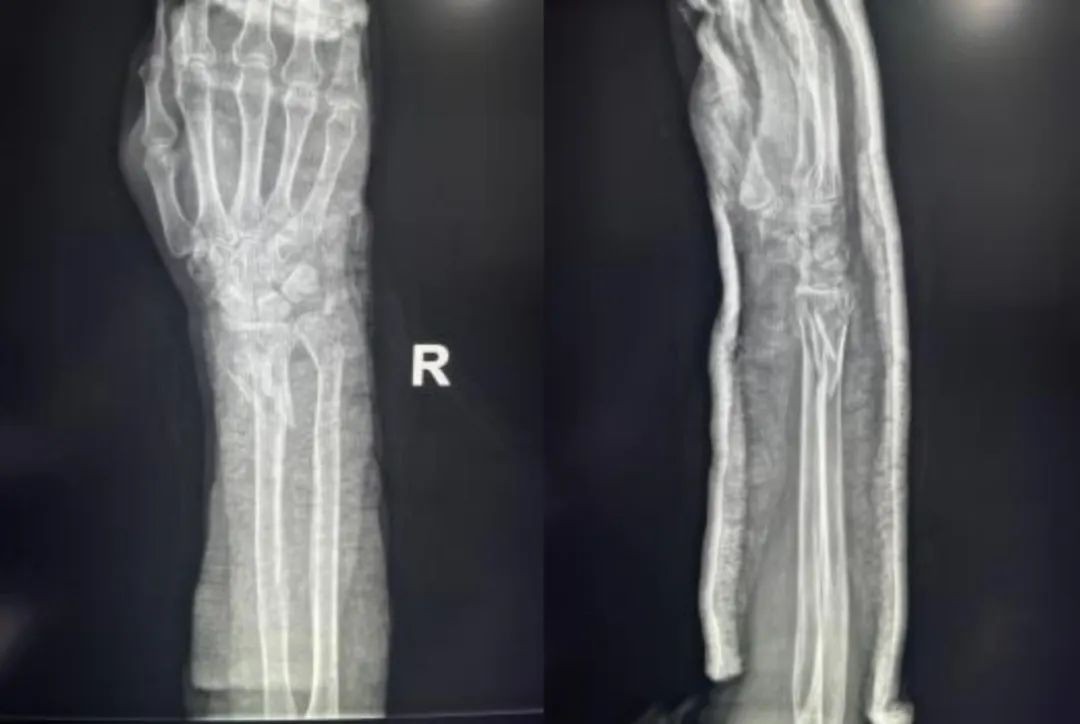 Caso de fijaci&oacute;n con placa volar para una fractura de radio distal 