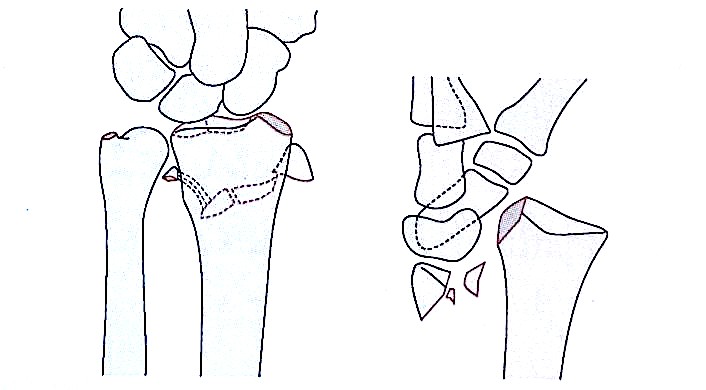 Ilustraci&oacute;n de fractura por avulsi&oacute;n del radio distal tipo IV de Fern&aacute;ndez 