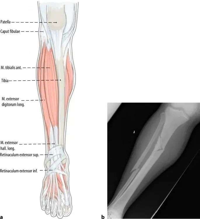 Fracturas de tibia, t&eacute;cnica de clavo intramedular suprapatelar-2