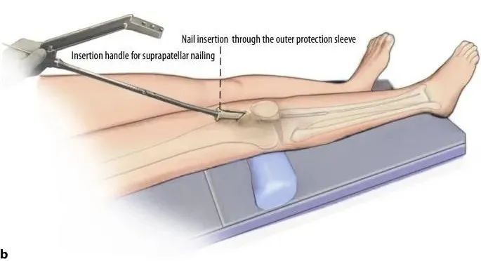 Fracturas de tibia, t&eacute;cnica de clavo intramedular suprapatelar-17