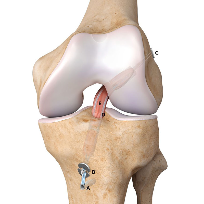 Aplicaci&oacute;n de sutura UHMWPE para la reconstrucci&oacute;n de ligamentos ACL y PCL