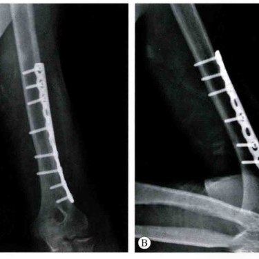 C&oacute;mo funcionan los implantes ortop&eacute;dicos