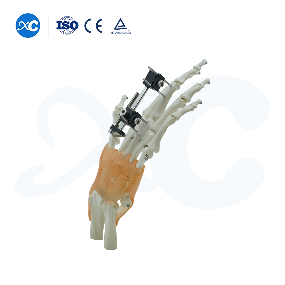 Mini fijador tipo extensión de compresión universal