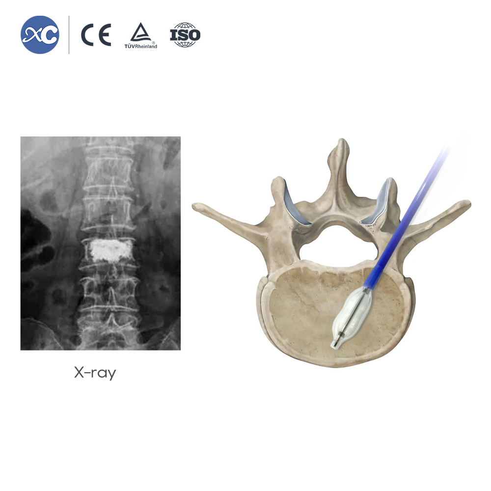 Sistema de cifoplastia (PKP/PVP): kit de cemento y globo para el cuerpo vertebral