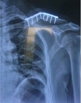 Complicaci&oacute;n de la fijaci&oacute;n de fractura de clav&iacute;cula.