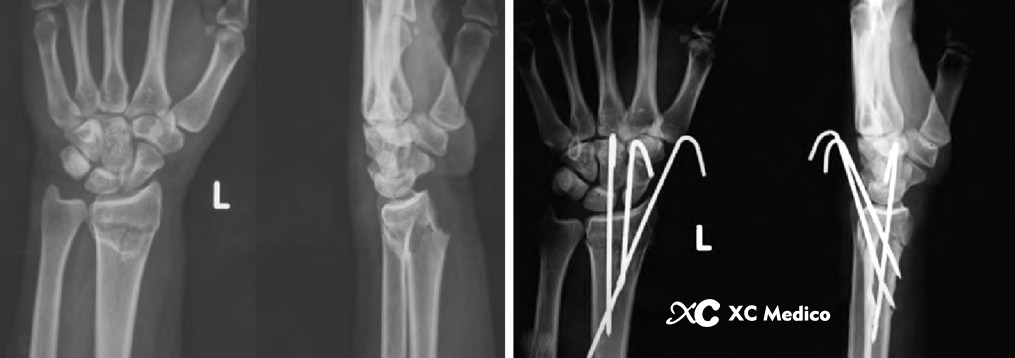 Principios de fijaci&oacute;n de la estiloides radial y dorsal de la aguja de Kirschner para fractura de radio distal Fijaci&oacute;n 