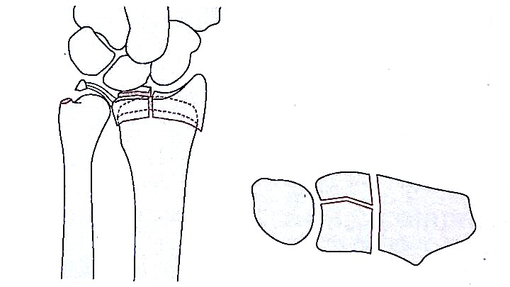 Ilustraci&oacute;n de fractura por compresi&oacute;n del radio distal tipo III de Fern&aacute;ndez 