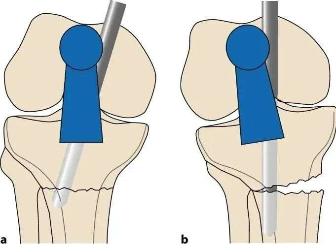 Fracturas de tibia, t&eacute;cnica de clavo intramedular suprapatelar-1