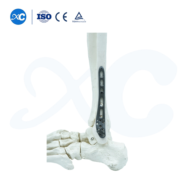 Placa de bloqueo para tibioperoneo distal-I