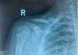 Evaluaci&oacute;n radiol&oacute;gica de una fractura de clav&iacute;cula.