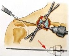 Fijaci&oacute;n intramedular de una fractura de clav&iacute;cula.