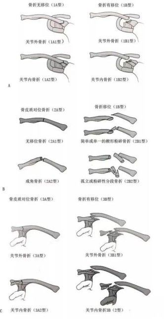 Clasificaci&oacute;n de Edimburgo de fracturas de clav&iacute;cula.