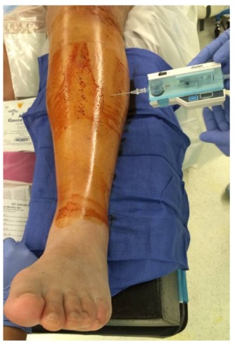T&eacute;cnica de fijaci&oacute;n de clavos intramedulares tibiales para el tratamiento de fracturas de tibia.