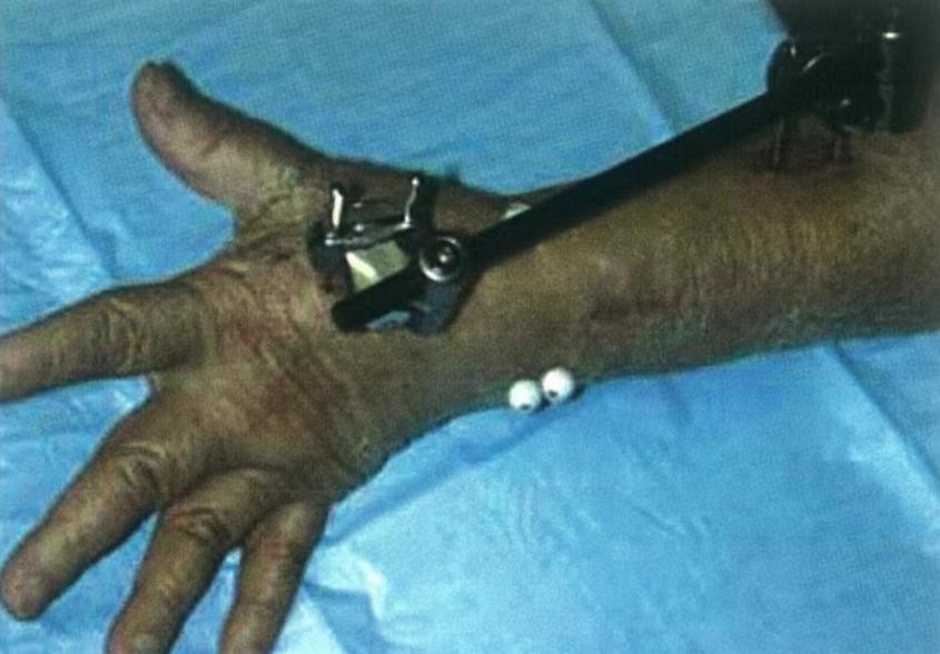 Fijaci&oacute;n externa que abarca la mu&ntilde;eca para fractura de radio distal 