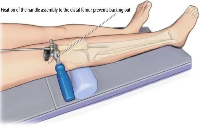 Fracturas de tibia, t&eacute;cnica de clavo intramedular suprapatelar-12