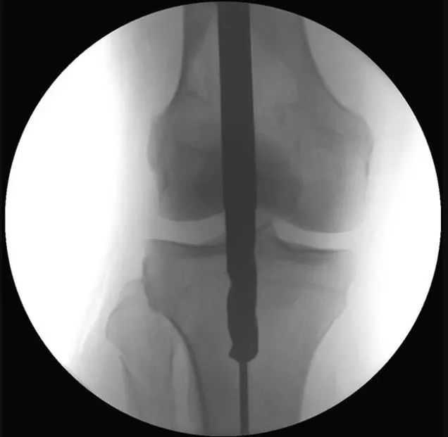 Fracturas de tibia, t&eacute;cnica de clavo intramedular suprapatelar-13