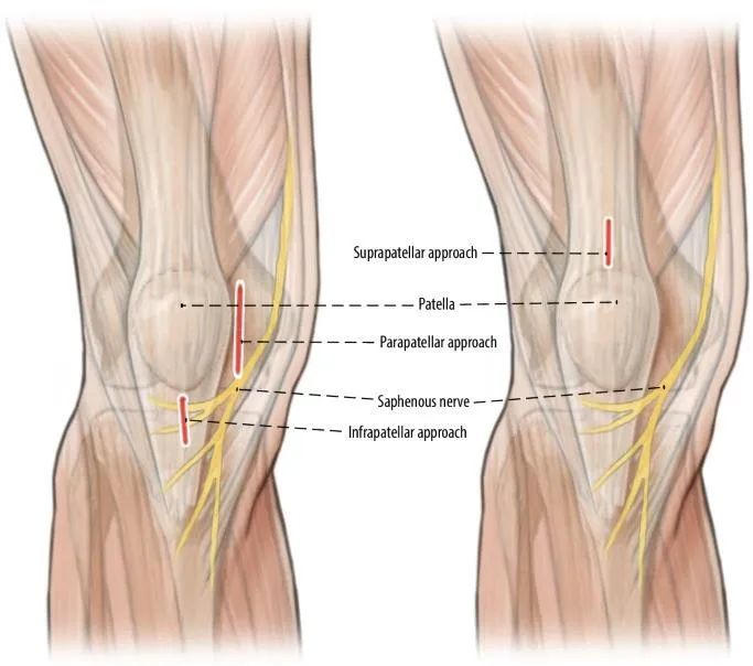 Fracturas de tibia, t&eacute;cnica de clavo intramedular suprapatelar-3