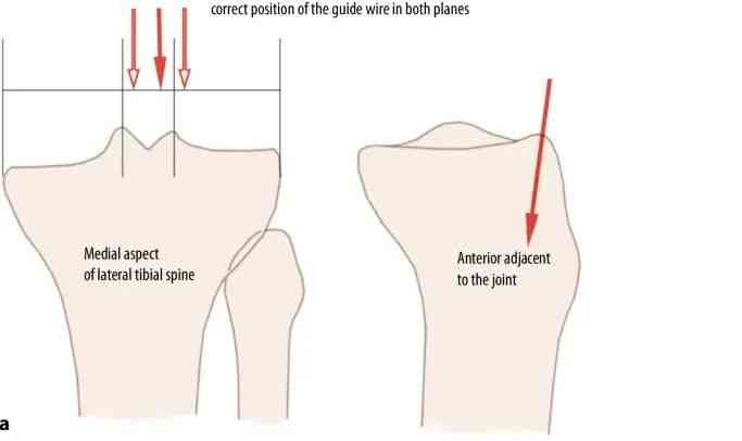 Fracturas de tibia, t&eacute;cnica de clavo intramedular suprapatelar-10