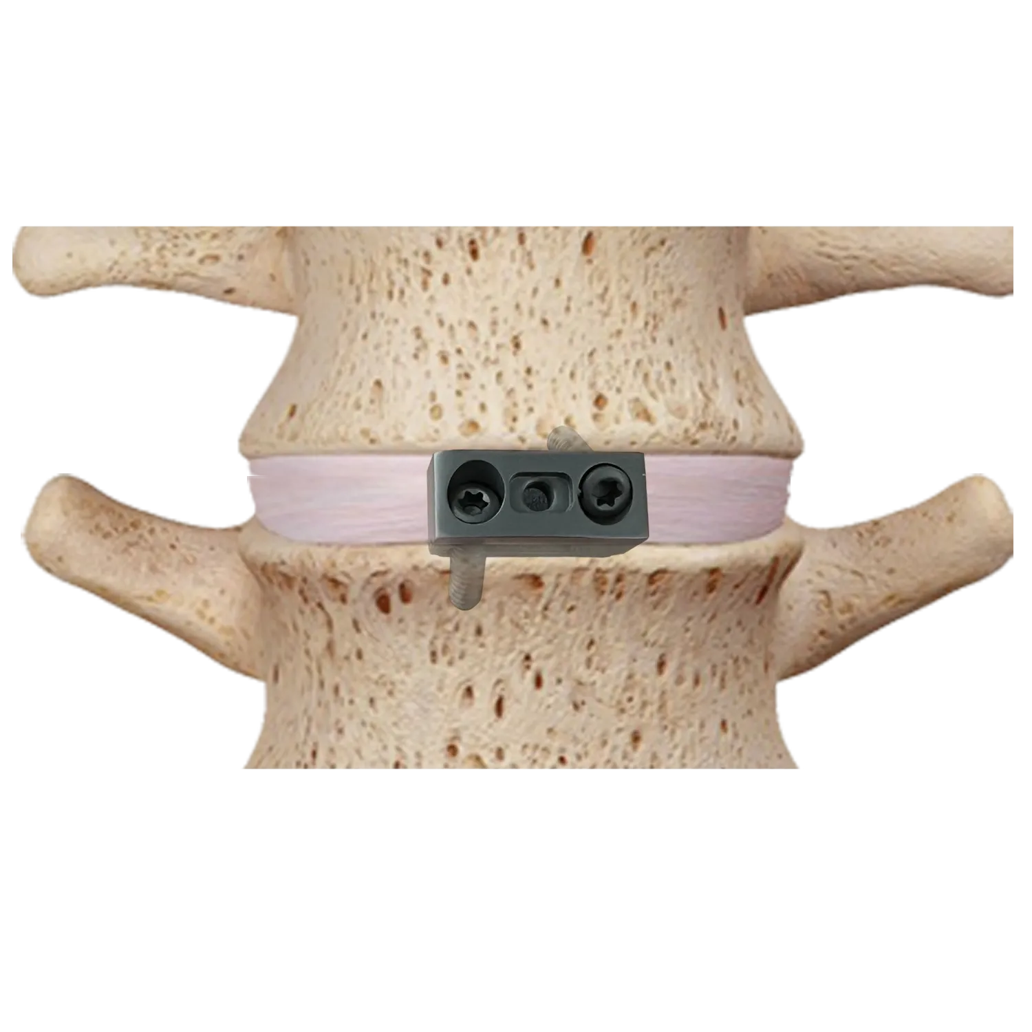 Colocaci&oacute;n de Cervical Titanium Cage-IV en el espacio intersom&aacute;tico cervical