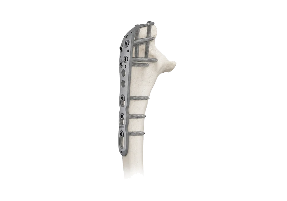 Locking plate pathway for proximal ulna fixation